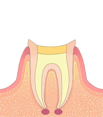 薬で埋めます